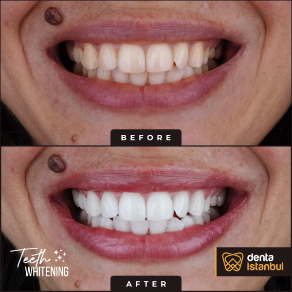 Denta-Istanbul-Happy-Smiles (1)
