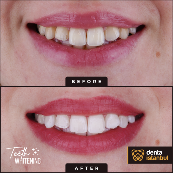 Denta-Istanbul-Happy-Smiles (10)