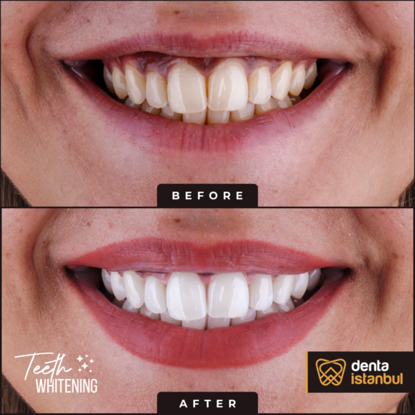 Denta-Istanbul-Happy-Smiles (3)