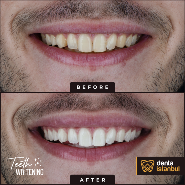 Denta-Istanbul-Happy-Smiles (4)