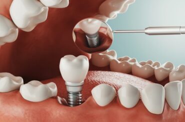dental-implant