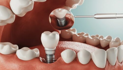 dental-implant
