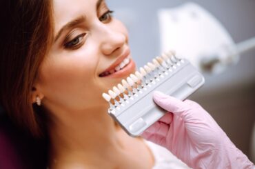 Beautiful woman smile with healthy teeth whitening. Matching shades of the implants. Healthy Smile.