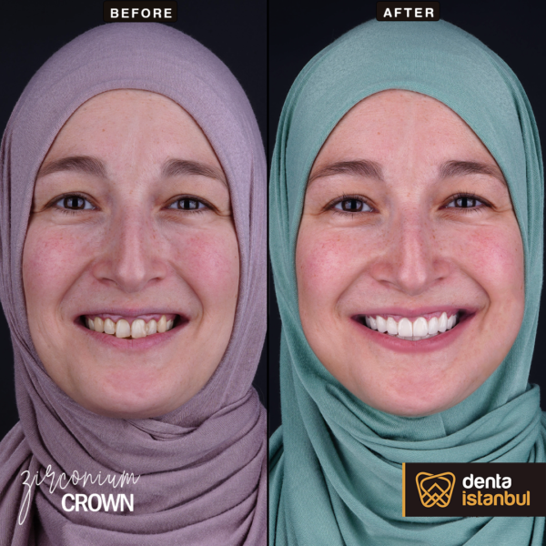Denta-Istanbul-Happy-Smiles (14)